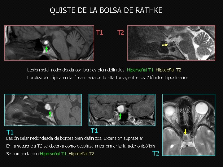 QUISTE DE LA BOLSA DE RATHKE T 1 T 2 Lesión selar redondeada con