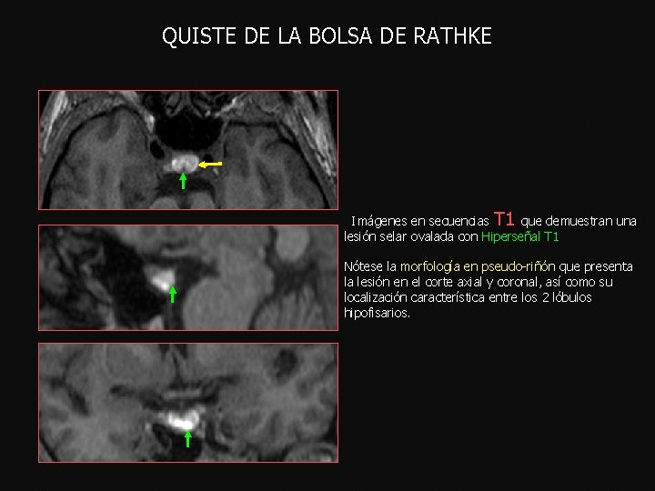 QUISTE DE LA BOLSA DE RATHKE Imágenes en secuencias que demuestran una T 1