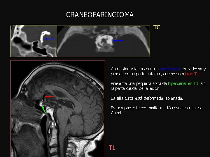 CRANEOFARINGIOMA TC Craneofaringioma con una calcificación muy densa y grande en su parte anterior,