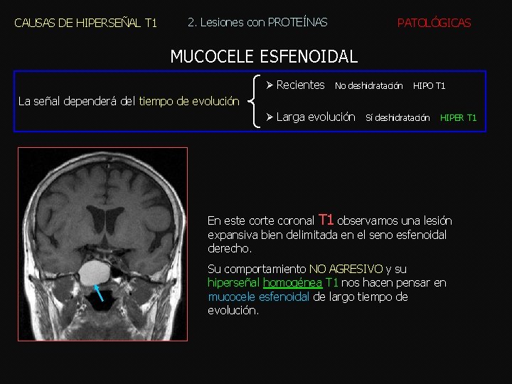 CAUSAS DE HIPERSEÑAL T 1 2. Lesiones con PROTEÍNAS PATOLÓGICAS MUCOCELE ESFENOIDAL Ø Recientes