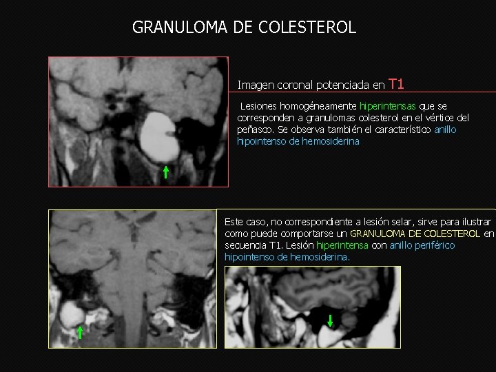 GRANULOMA DE COLESTEROL Imagen coronal potenciada en T 1 Lesiones homogéneamente hiperintensas que se