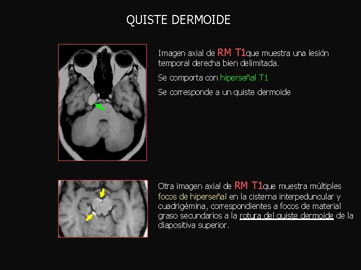  QUISTE DERMOIDE Imagen axial de RM T 1 que muestra una lesión temporal