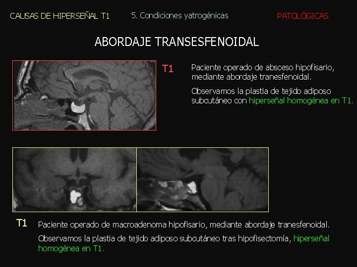 CAUSAS DE HIPERSEÑAL T 1 5. Condiciones yatrogénicas PATOLÓGICAS ABORDAJE TRANSESFENOIDAL T 1 Paciente