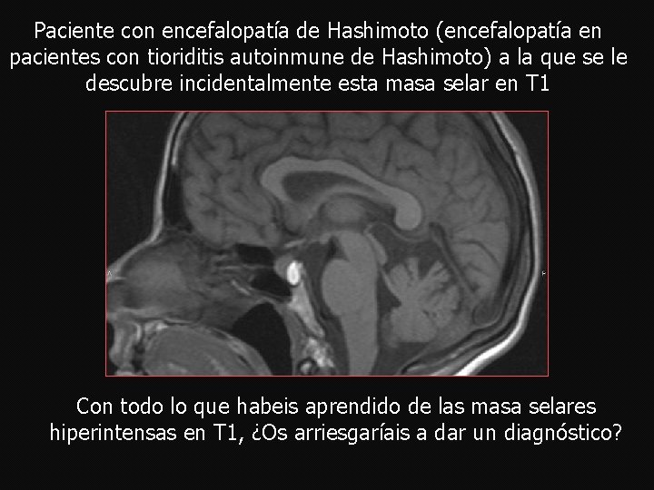 Paciente con encefalopatía de Hashimoto (encefalopatía en pacientes con tioriditis autoinmune de Hashimoto) a