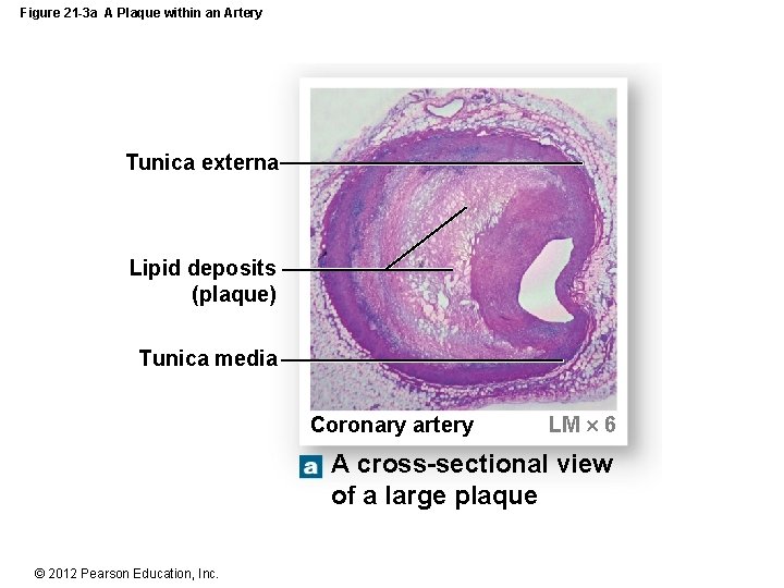 Figure 21 -3 a A Plaque within an Artery Tunica externa Lipid deposits (plaque)