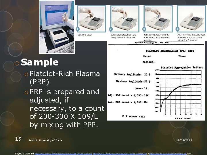 o Sample o Platelet Rich Plasma (PRP) o PRP is prepared and adjusted, if
