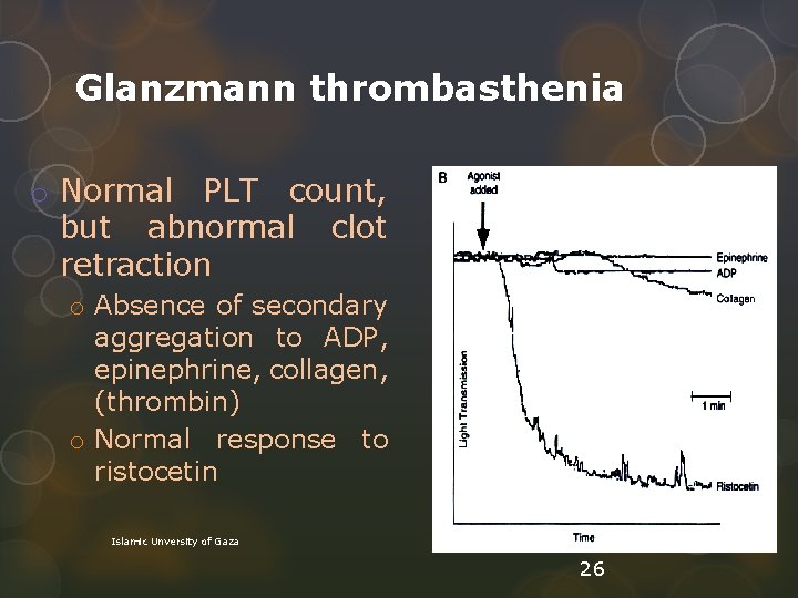 Glanzmann thrombasthenia o Normal PLT count, but abnormal clot retraction o Absence of secondary