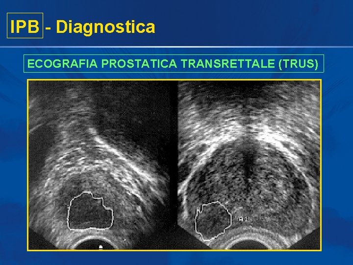 IPB - Diagnostica ECOGRAFIA PROSTATICA TRANSRETTALE (TRUS) IPB - Diagnostica ECOGRAFIA PROSTATICA TRANSRETTALE (TRUS)