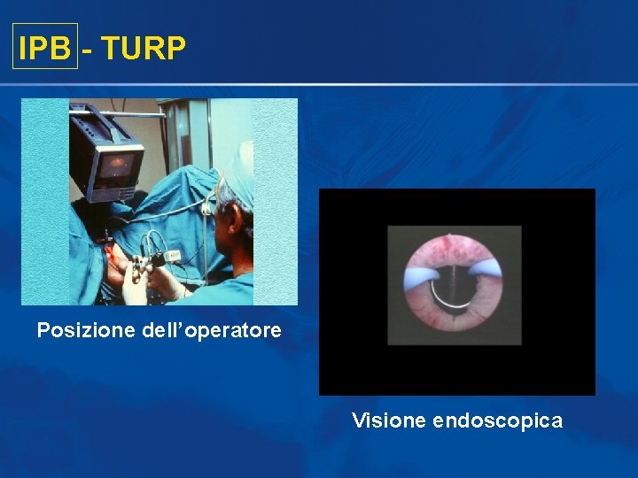 IPB - TURP Posizione dell’operatore Visione endoscopica IPB - TURP Posizione dell’operatore Visione endoscopica