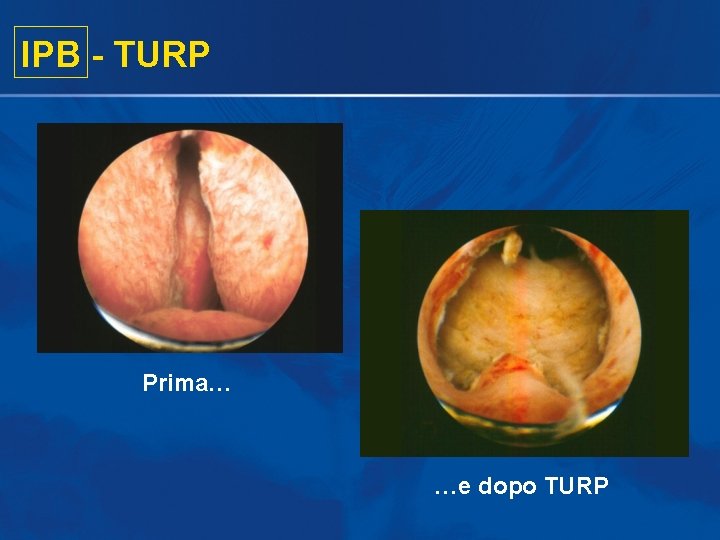 IPB - TURP Prima… …e dopo TURP IPB - TURP Prima… …e dopo TURP