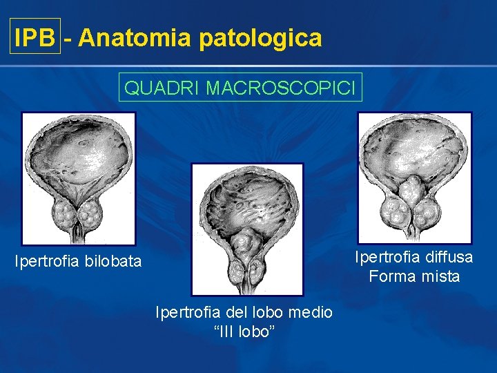 IPB - Anatomia patologica QUADRI MACROSCOPICI Ipertrofia diffusa Forma mista Ipertrofia bilobata Ipertrofia del