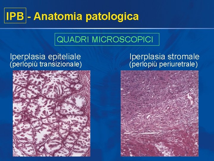 IPB - Anatomia patologica QUADRI MICROSCOPICI Iperplasia epiteliale (perlopiù transizionale) Iperplasia stromale (perlopiù periuretrale) IPB - Anatomia patologica QUADRI MICROSCOPICI Iperplasia epiteliale (perlopiù transizionale) Iperplasia stromale (perlopiù periuretrale)