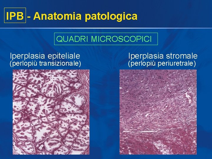 IPB - Anatomia patologica QUADRI MICROSCOPICI Iperplasia epiteliale (perlopiù transizionale) Iperplasia stromale (perlopiù periuretrale)