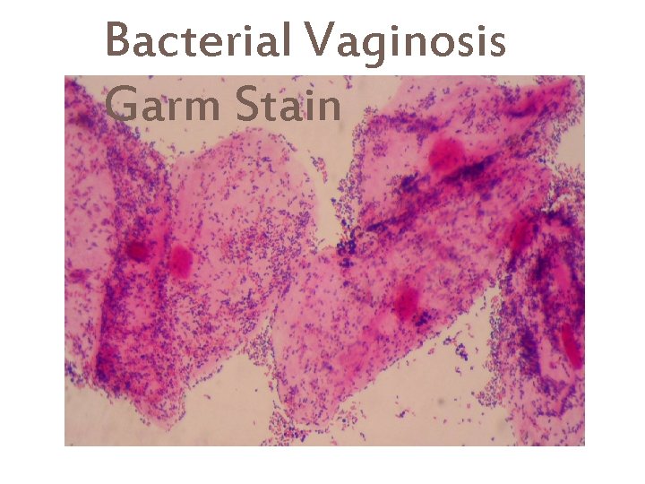 Bacterial Vaginosis Garm Stain 