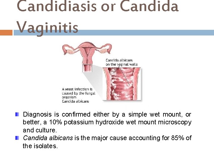Candidiasis or Candida Vaginitis Diagnosis is confirmed either by a simple wet mount, or