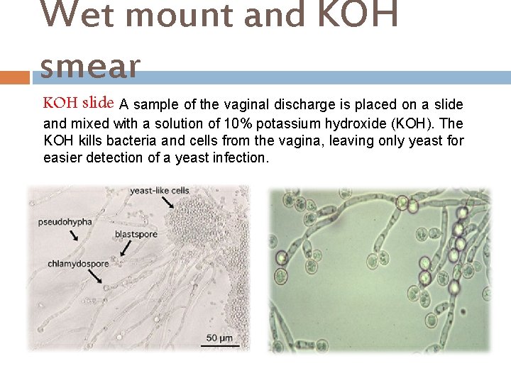 Wet mount and KOH smear KOH slide A sample of the vaginal discharge is