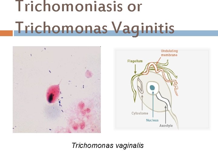 Trichomoniasis or Trichomonas Vaginitis Trichomonas vaginalis 