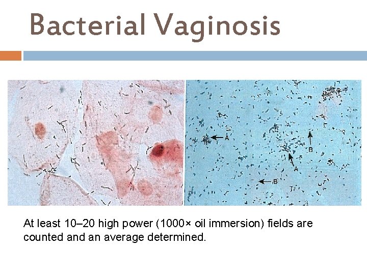 Bacterial Vaginosis At least 10– 20 high power (1000× oil immersion) fields are counted