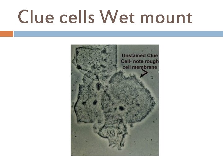 Clue cells Wet mount 