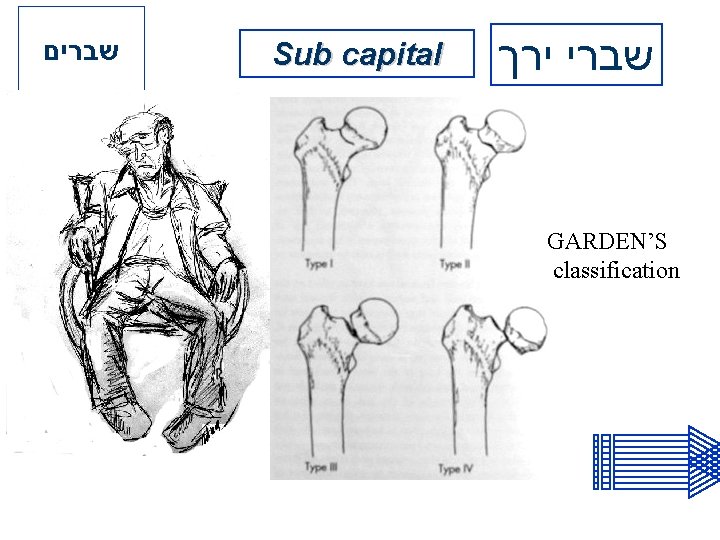  שברים Sub capital שברי ירך GARDEN’S classification 