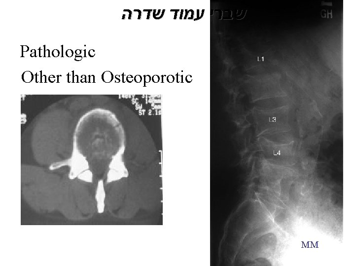  שברי עמוד שדרה Pathologic Other than Osteoporotic MM 