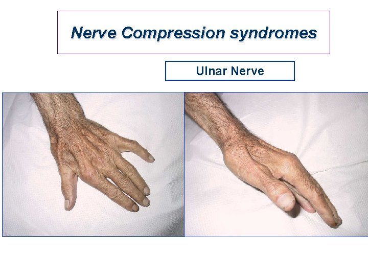 Nerve Compression syndromes Ulnar Nerve 