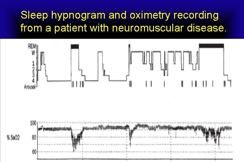 Sleep hypnogram and oximetry recording from a patient with neuromuscular disease. 