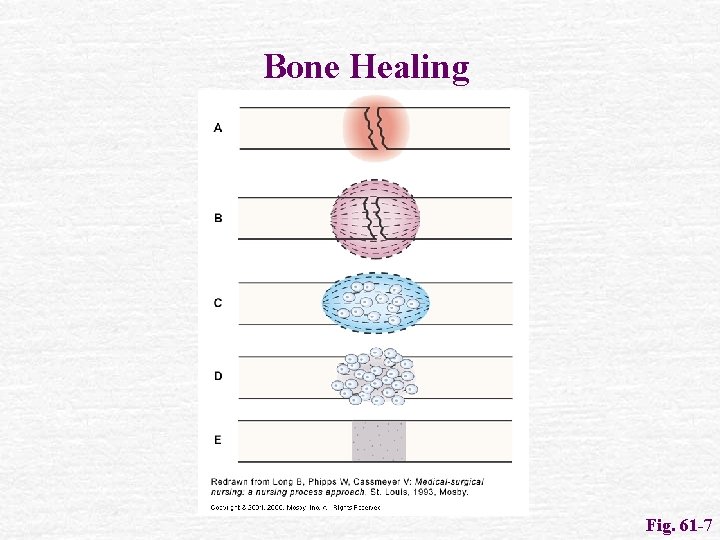 Bone Healing Fig. 61 -7 
