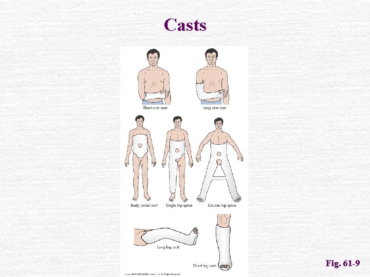 Casts Fig. 61 -9 