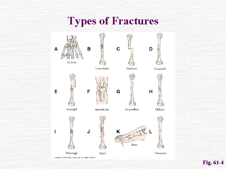 Types of Fractures Fig. 61 -4 