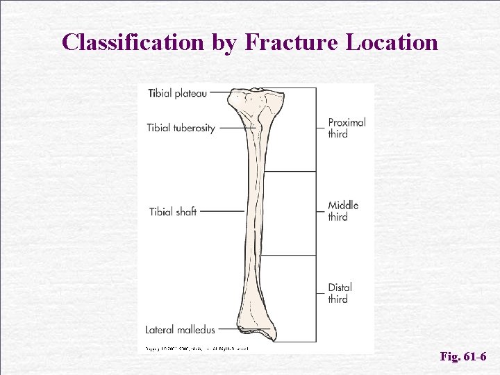 Classification by Fracture Location Fig. 61 -6 