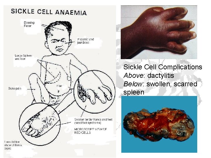 Sickle Cell Complications Above: dactylitis Below: swollen, scarred spleen Sickle Cell Complications Above: dactylitis Below: swollen, scarred spleen