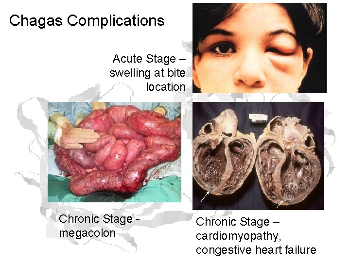 Chagas Complications Acute Stage – swelling at bite location Chronic Stage megacolon Chronic Stage