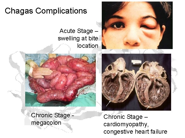 Chagas Complications Acute Stage – swelling at bite location Chronic Stage megacolon Chronic Stage Chagas Complications Acute Stage – swelling at bite location Chronic Stage megacolon Chronic Stage