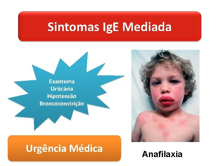 Sintomas Ig. E Mediada Exantema Urticária Hipotensão Broncoconstrição Urgência Médica Anafilaxia 