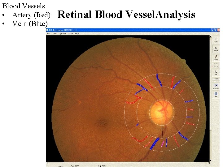 Blood Vessels • Artery (Red) • Vein (Blue) Retinal Blood Vessel. Analysis 