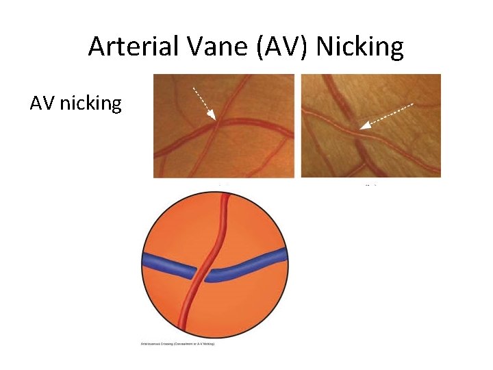 Large Analysis of microvascular lesions in the brain