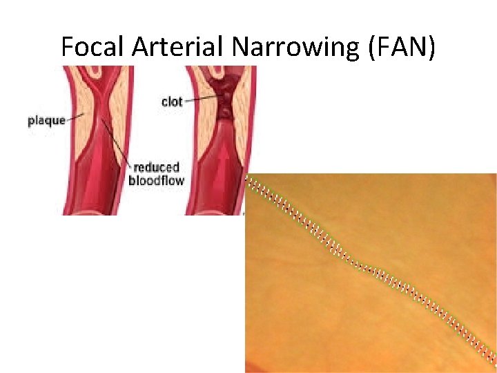 Focal Arterial Narrowing (FAN) 