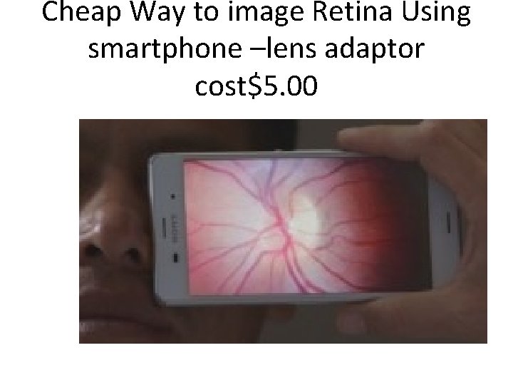 Cheap Way to image Retina Using smartphone –lens adaptor cost$5. 00 