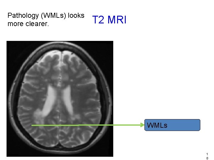 Pathology (WMLs) looks more clearer. T 2 MRI WMLs 1 8 