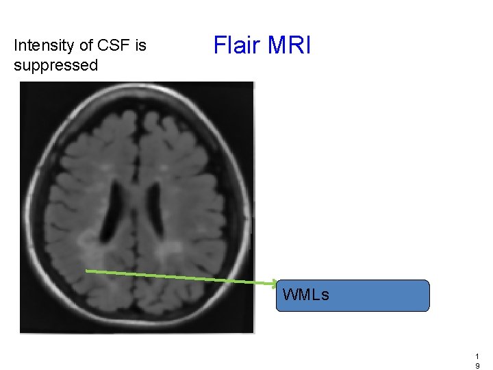 Intensity of CSF is suppressed Flair MRI WMLs 1 9 