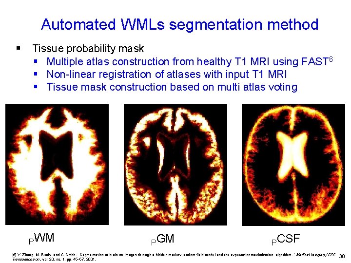 Automated WMLs segmentation method § Tissue probability mask § Multiple atlas construction from healthy