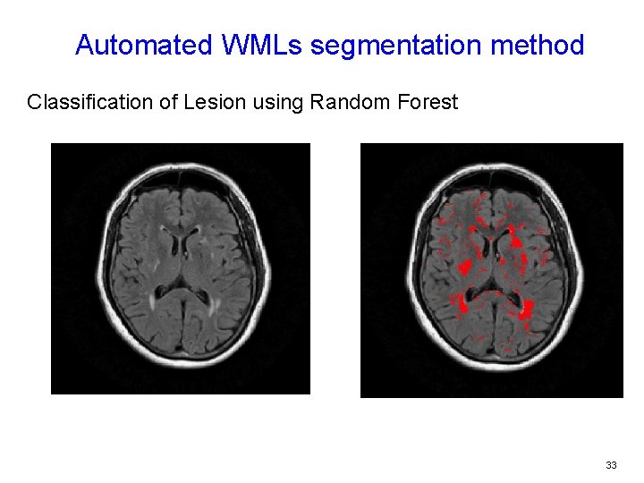 Automated WMLs segmentation method Classification of Lesion using Random Forest 33 