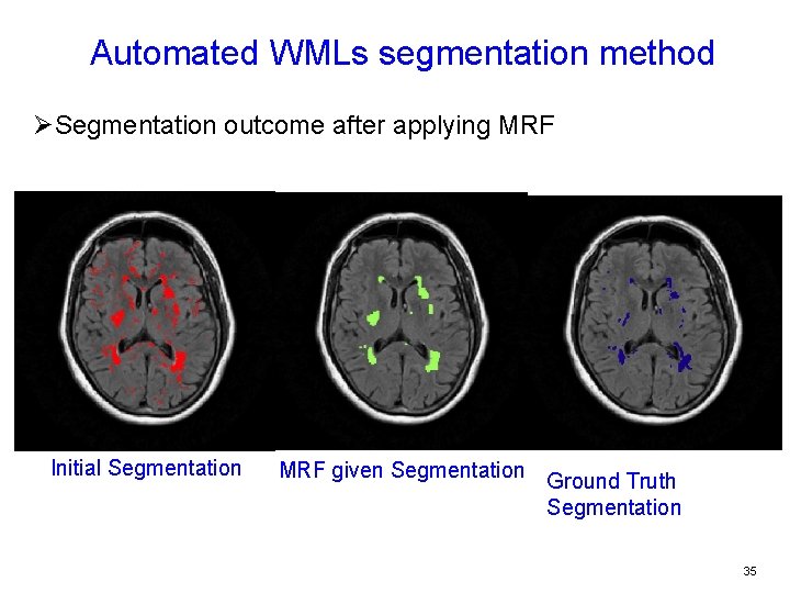 Automated WMLs segmentation method ØSegmentation outcome after applying MRF Initial Segmentation MRF given Segmentation