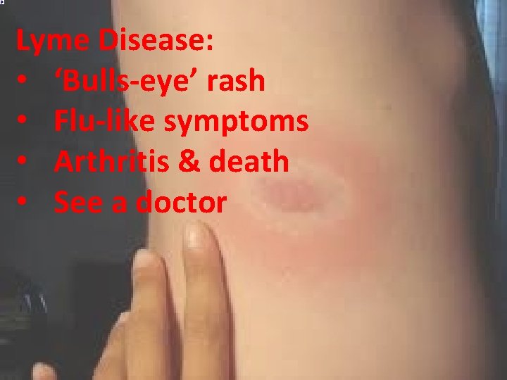 Lyme Disease: • ‘Bulls-eye’ rash • Flu-like symptoms • Arthritis & death • See