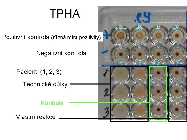 TPHA +++ ++ + +/Pozitivní kontrola (různá míra pozitivity) Negativní kontrola Pacienti (1, 2,