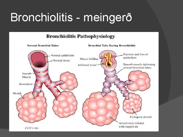 Bronchiolitis - meingerð 
