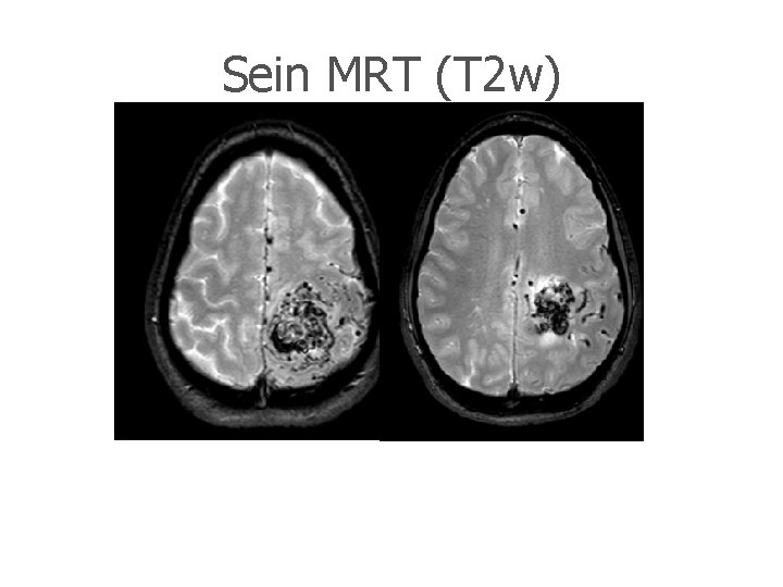 Sein MRT (T 2 w) 