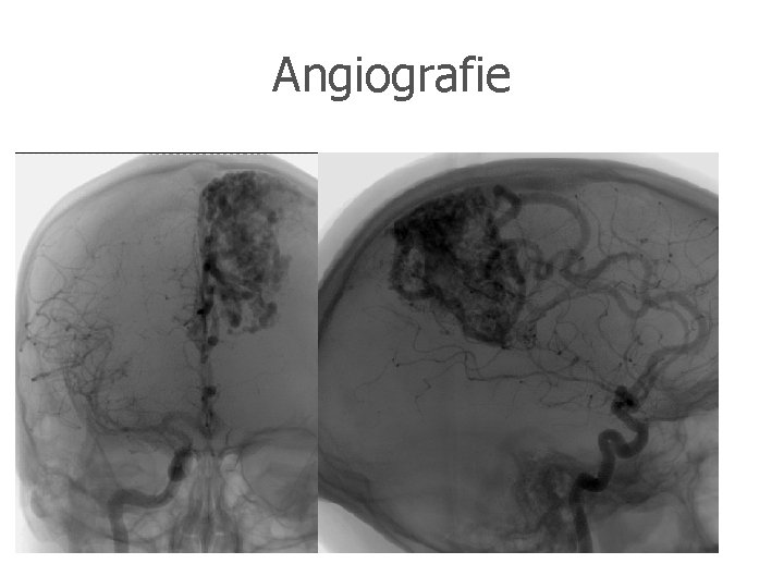 Angiografie 