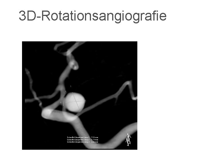 3 D-Rotationsangiografie 